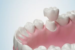 How-Do-Dental-Crowns-Protect-Teeth