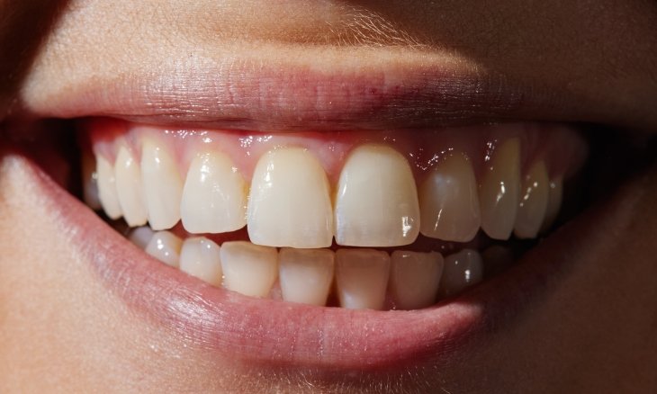 Keeping My Own Teeth – Is It Worth It?